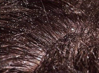 Why Your Anti-Dandruff Shampoo Stops Working: Real Causes of Dandruff (and What Actually Works)