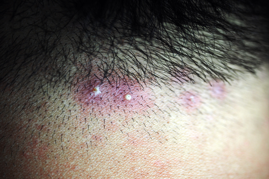 Causes of Scalp Acne and How to Prevent It