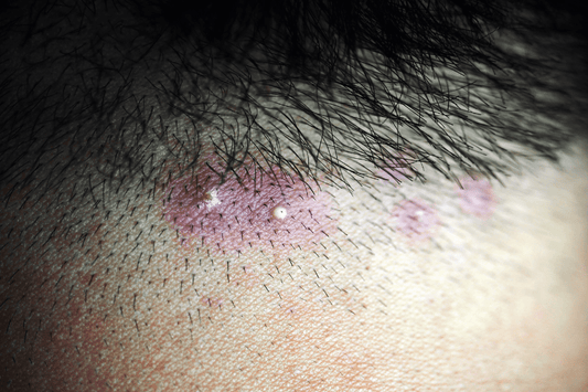 Causes of Scalp Acne and How to Prevent It