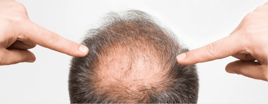 Why My Hair Is Falling? What Causes An Unhealthy Scalp? (Factors Of Unhealthy Scalp) How To Get Healthy Scalp At Home?